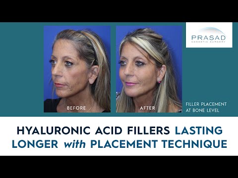 How Facial Cosmetic Fillers can Last Longer with Placement Technique