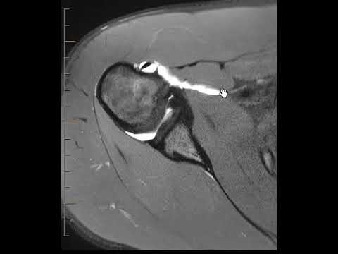 Superior glenohumeral ligament tear