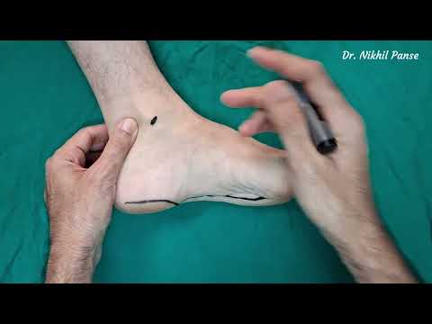 Medial plantar artery flap planning