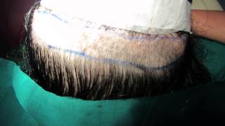 preview picture of video 'Female Hair Transplant in Bangalore, India'