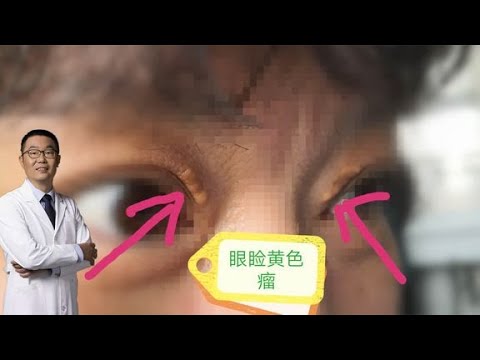 眼睛周圍有斑