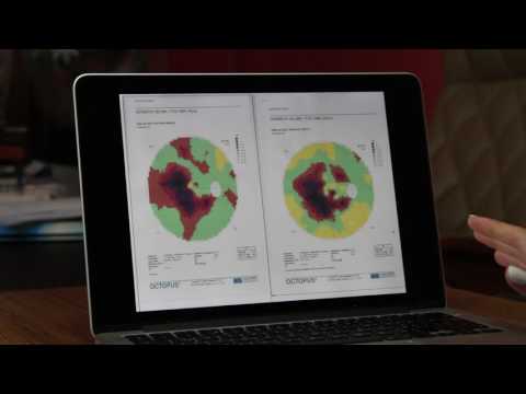Stargardt Disease Treatment ( in Russian ) - part 3 - FIRATLI CLINIC