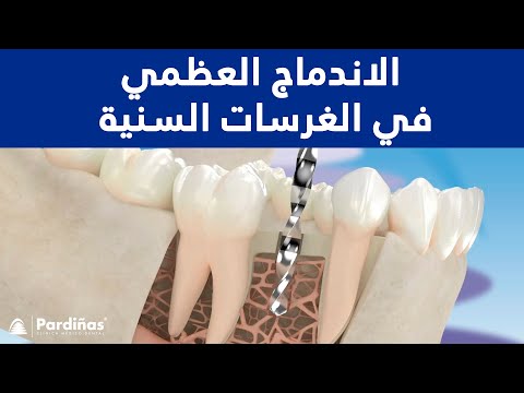 © الاندماج العظمي في الغرسات السنية