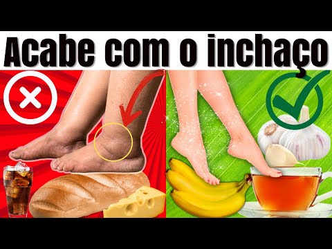 FLUID RETENTION ALERT SIGNS: WHAT TO EAT TO REMOVE THE SWELLING IN THE FEET, LEGS AND BELLY