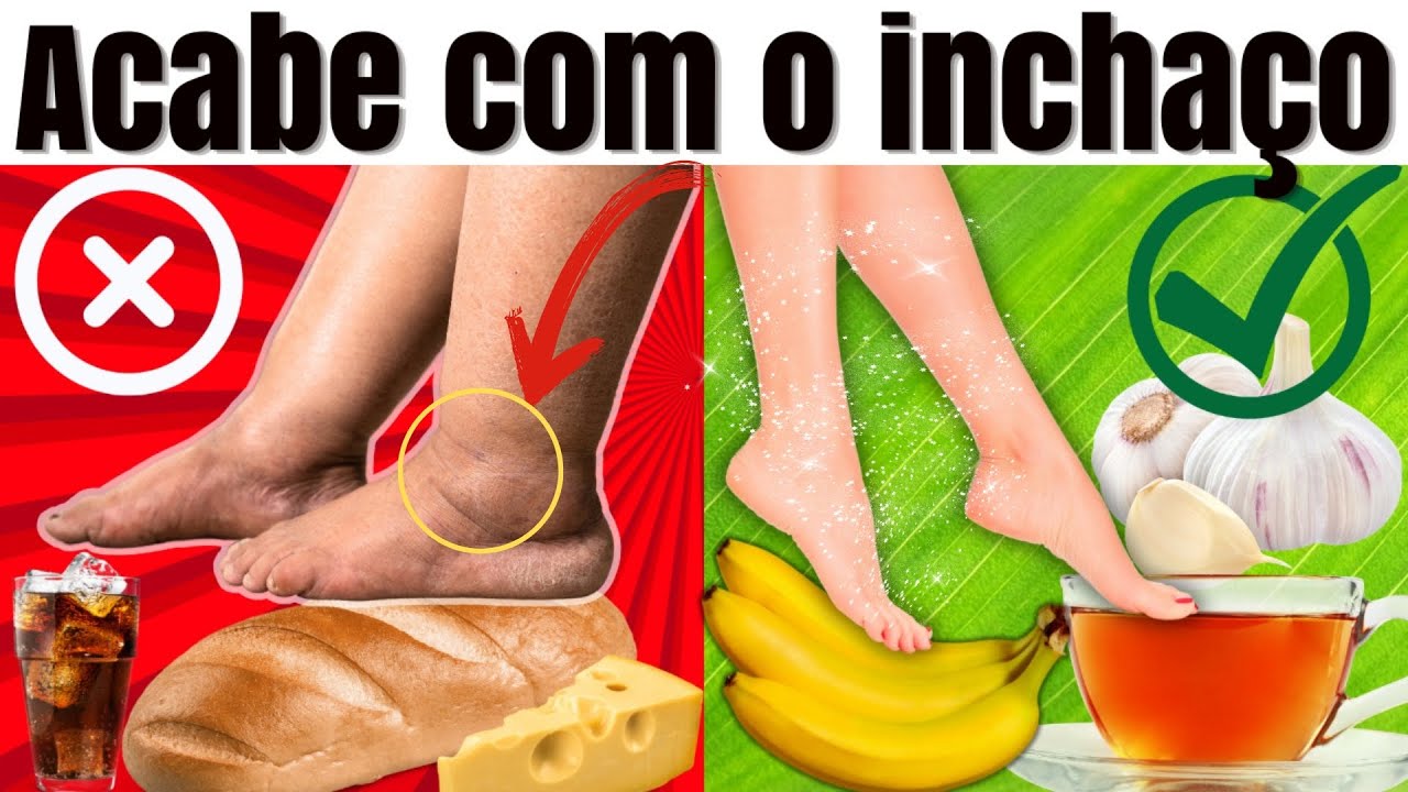 FLUID RETENTION ALERT SIGNS: WHAT TO EAT TO REMOVE THE SWELLING IN THE FEET, LEGS AND BELLY