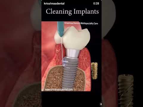 Keep your Dental implants with proper care at Krisshnaa Dental & Multispeciality Care Delhi.