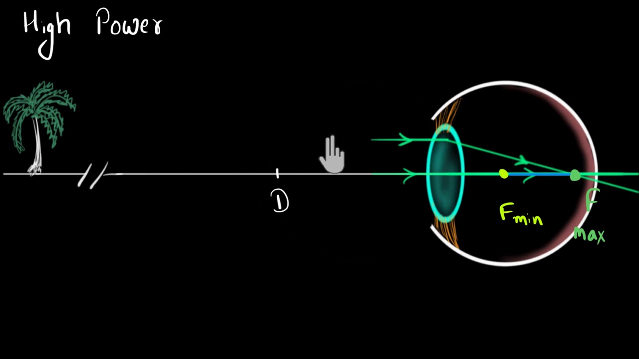 Myopia & Hypermetropia (Hindi) | Human eye and the colourful world | Physics | Khan Academy