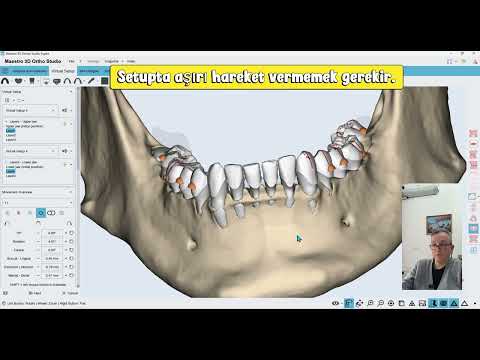 In-house Aligners and DIY solutions - Part 2