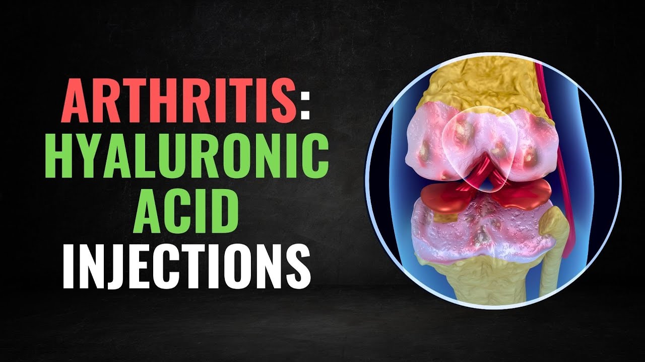 The Truth About Hyaluronic Acid Injections and Knee Arthritis
