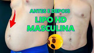 ANTES E DEPOIS LIPO HD MASCULINA