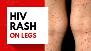 HIV Rash on Legs