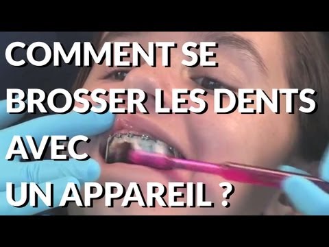 comment nettoyer appareil dentaire