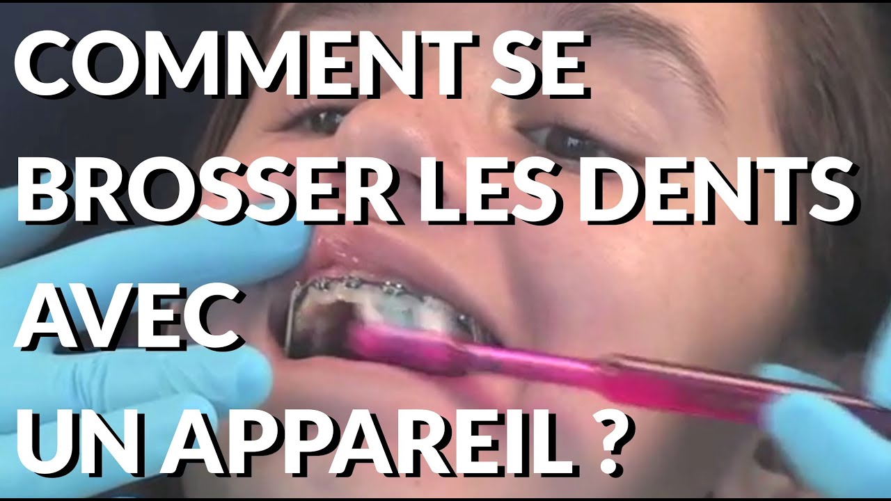 Comment se brosser les dents avec un appareil dentaire  Appareil-dentaire.info