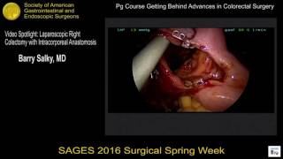 Download Lagu Video spotlight: Laparoscopic right colectomy with intracorporeal anastomosis Thumbnail