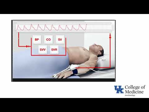 image-What is normal pulse pressure variation?