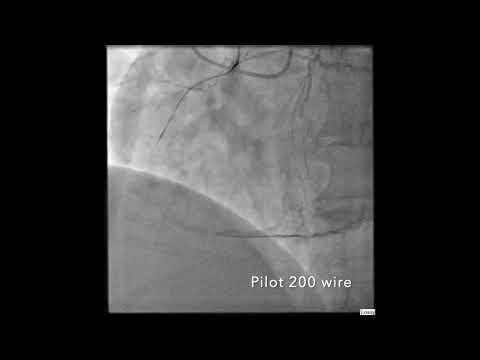 Right coronary artery complex CTO PCI via AWE technique