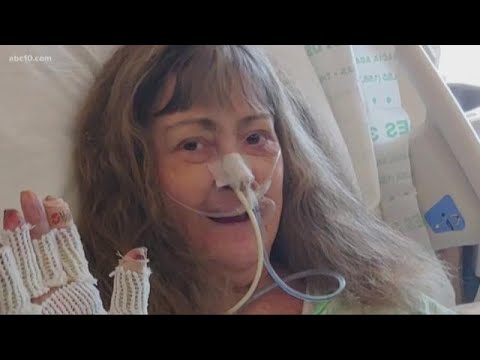 Camp Fire survivors still recovering from third-degree burns, concerned with future medical care