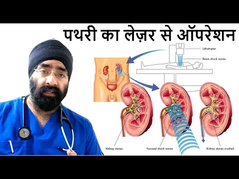 Rx Kidney Stone #4 (Hindi) गुर्दे की पथरी का लेज़र से इलाज | Lithotripsy |HIN| Dr.Education Video