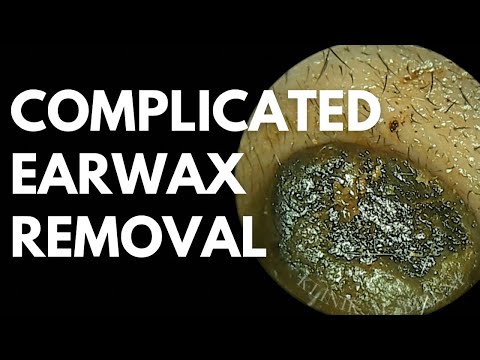 The Most Complicated Earwax Removal Ever‼️