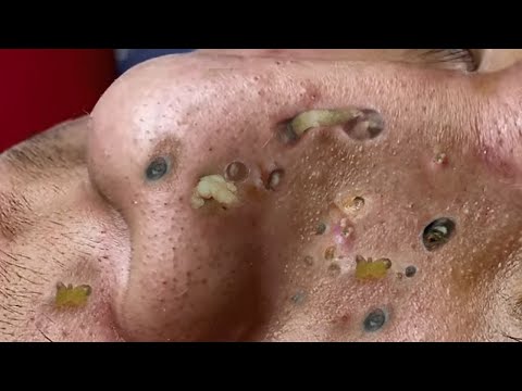 Huge pimple popper blackhead