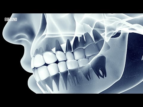 Metastasierung bei Lungenkrebs im Hüftgelenk Drogen den Namen der Gelenke zu blockieren