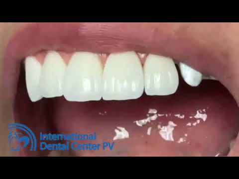 What to Expect During Try-In and Conversion Denture Placement in Puerto Vallarta, Mexico