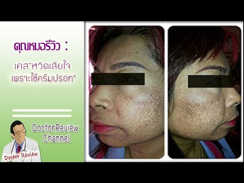 โรคสะเก็ดเงินบนศีรษะและสี มาตรฐานการรักษาของโรคสะเก็ดเงิน 2014