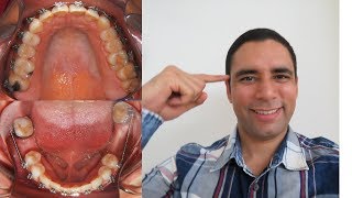 Hablemos de Ortodoncia! Caso Clinico 8: Paciente adulta de Ortodoncia.