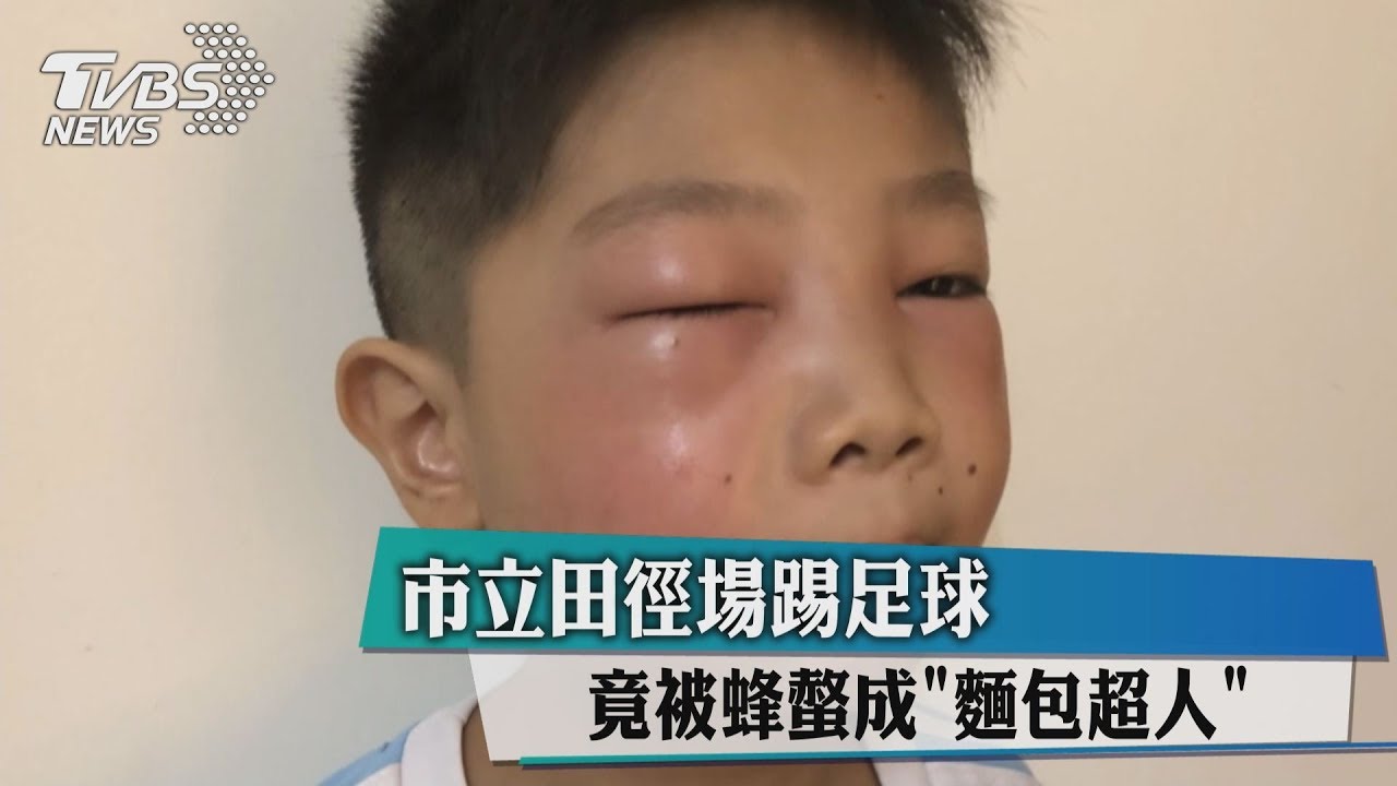 市立田徑場踢足球 竟被蜂螫成「麵包超人」