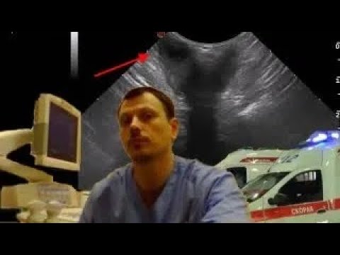 Pediatric Soft tissue ultrasound - bilateral paraproctitis