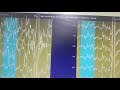 Holter monitor 24 Hours in Hindi l introduction to Holter analysis l by Babita