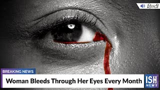 Woman Bleeds Through Her Eyes Every Month