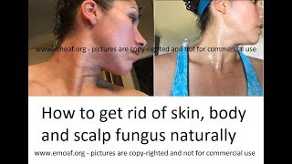 How To Kill Severe Ringworm on Skin, Body & Scalp for adults and kids