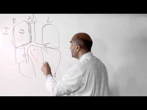 image-What is the life expectancy of someone with Stage 1 lung cancer? 