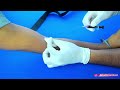 How To Do Venous Blood Sampling (Venipuncture) : Step-by-Step Description of Procedure : Clinicals