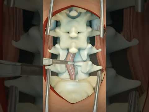 Lumbar Discectomy || 3D Animation #4k #animation #asmr