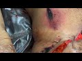 AUTOPSY Also Known As Postmortem Medical Examination IS The BODY OF EVIDENCE