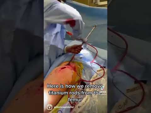 Here is how we remove titanium rods from the femur..