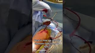 Here is how we remove titanium rods from the femur..