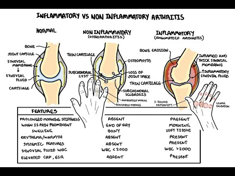 Osteoarthritis Overview causes pathophysiology investigations treatment