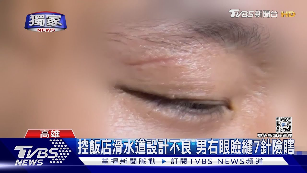 控飯店滑水道設計不良 男右眼瞼縫7針險瞎眼