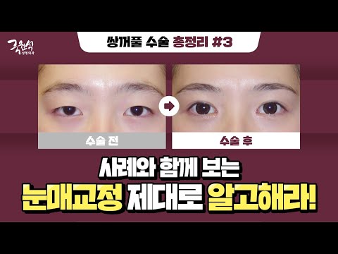 눈매교정에도 절개법과 매몰법이 있다는 사실! 알고 계셨나요?!