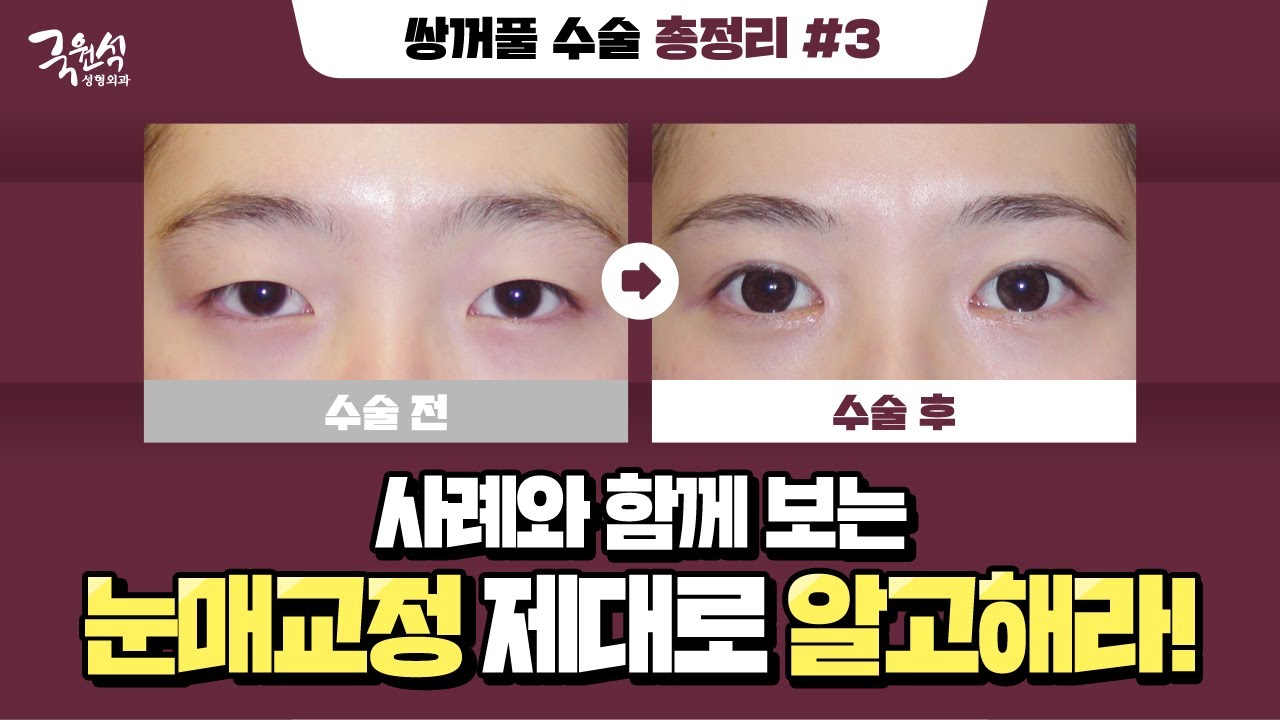눈매교정에도 절개법과 매몰법이 있다는 사실! 알고 계셨나요?! - 추천 영상