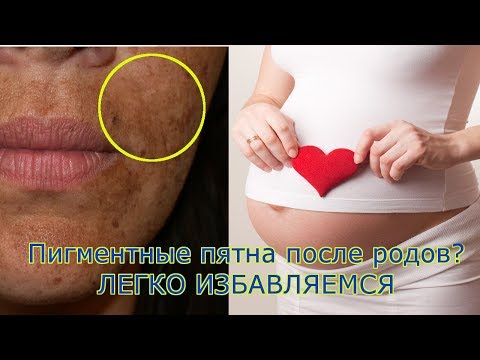 Маски от веснушек быстрый эффект Маски от пигментных пятен веснушек на лице