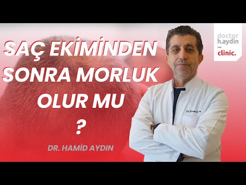 Saç Ekiminden Sonra Morluk Olur mu? - Dr. Hamid AYDIN