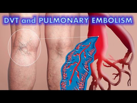 DVT and Pulmonary Embolism (Updated 2022) - CRASH! Medical Review Series
