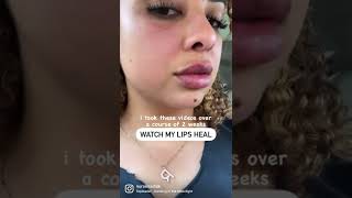 Lip filler healing process