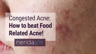 Congested Acne: How to manage Food Related Acne