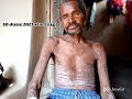 Psoriasis Ka Results AWPL