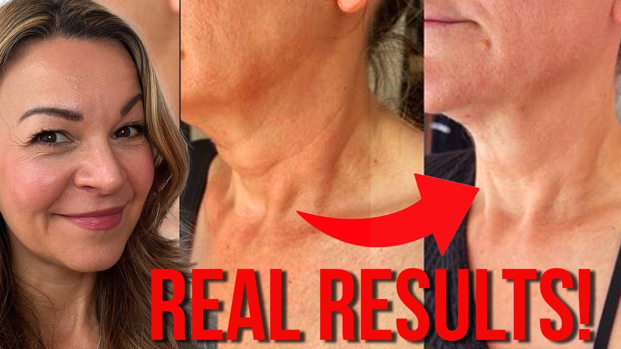 DIY turkey neck fix | Aesthetician got dramatic lift with this simple technique